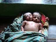 В бангладеш родился младенец с двумя головами