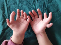 Руки девочки до операции