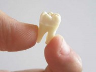 Уникальный случай: врачи удалили подростку выросший в яичке зуб (фото)