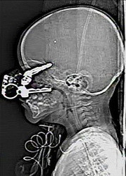 Годовалый ребенок остался полностью здоров после того, как напоролся на ключи от машины, которые через глаз прошли прямо в мозг