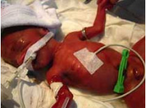 Житомирские врачи впервые в украине выходили младенца, при рождении весившего 490 граммов!