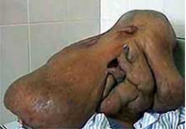 Мужчине удалили с головы 15-килограммовую опухоль