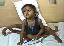 Двухлетней индианке, родившейся с четырьмя руками и четырьмя ногами, удалят лишние конечности