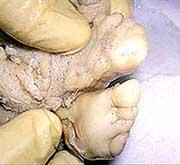 Из-под лопатки у 35-летнего уральского тракториста врачи извлекли&#133; Зародыш его брата-близнеца