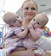 Американские врачи успешно разделили сиамских близнецов, родившихся с общими внутренними органами
