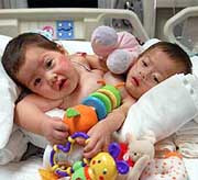 80 американских врачей в течение суток разделяли 10-месячных сиамских близнецов