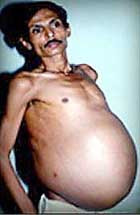 Индийские хирурги прооперировали&#133; «беременного» мужчину, удалив из его брюшной полости недоразвитого брата-близнеца