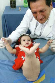 Перуанские медики готовят к операции девочку, которая родилась со сросшимися ногами