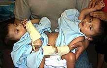 Сингапурские медики разделили сиамских близнецов, родившихся с тремя ногами на двоих