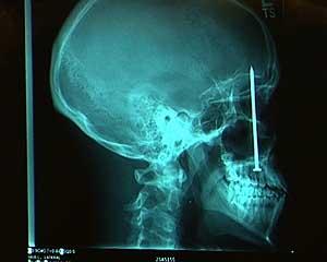 У пациента, который жаловался на зубную боль, стоматолог обнаружил в черепе&#133; 10-сантиметровый гвоздь