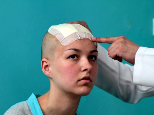 Наталье Титовой вживили в мозг нейростимулятор, избавляющий от торсионной дистонии