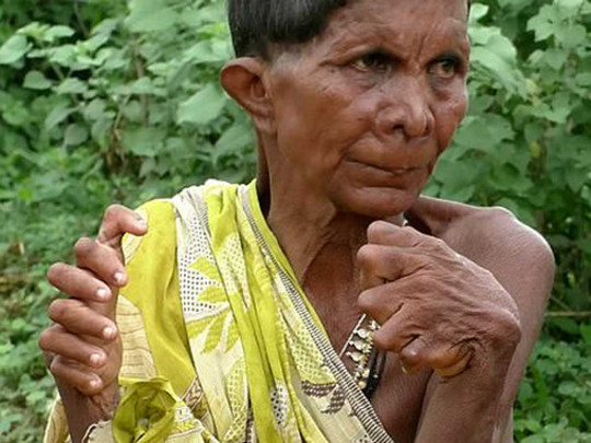 Индияская женщина с большим количеством пальцев