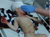 раненый под Мариуполем ребенок