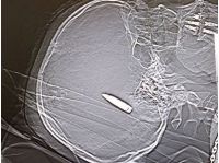 В Днепре нейрохирурги спасают бойца с пулей в мозге
