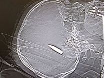 В Дніпрі нейрохірурги рятують бійця з кулею в мозку