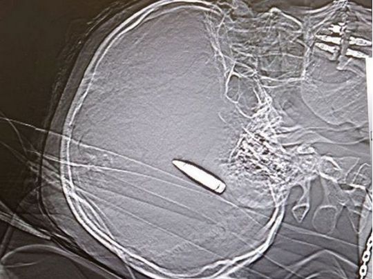 В Дніпрі нейрохірурги рятують бійця з кулею в мозку