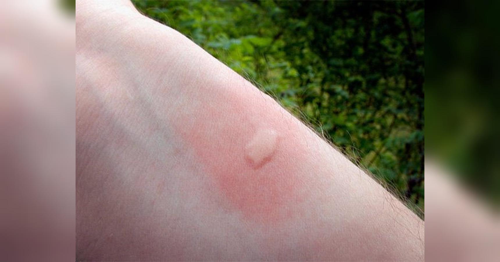 Почему чешутся комариные укусы?